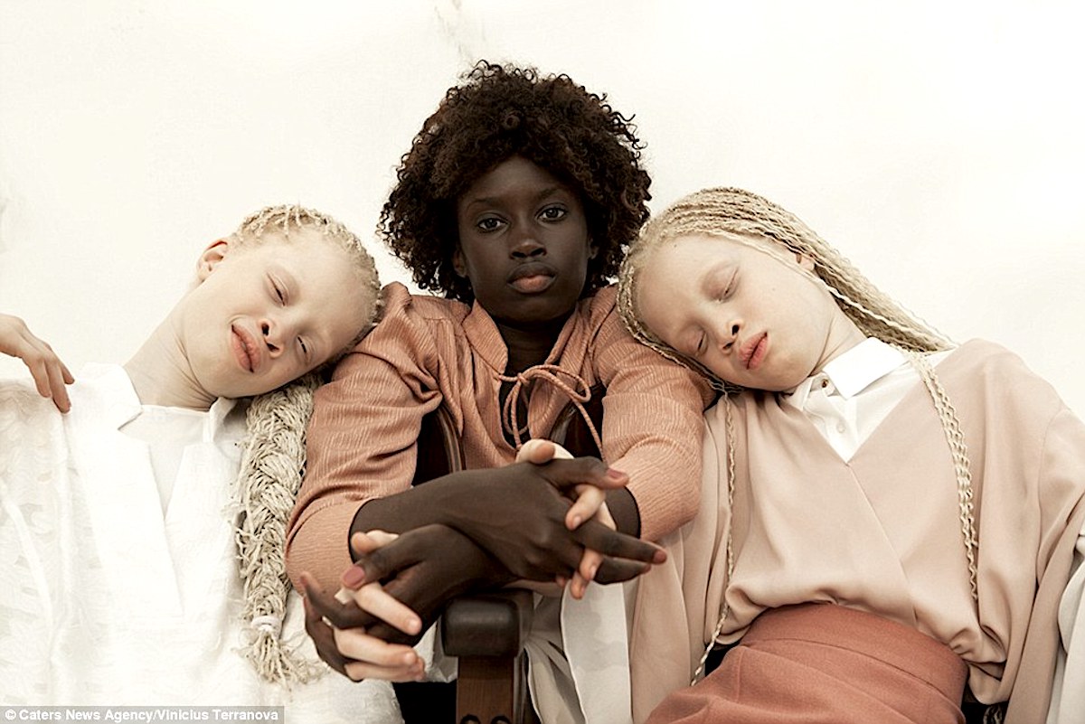 Albinism, African Communities, African Lives, KOLUMN Magazine, KOLUMN