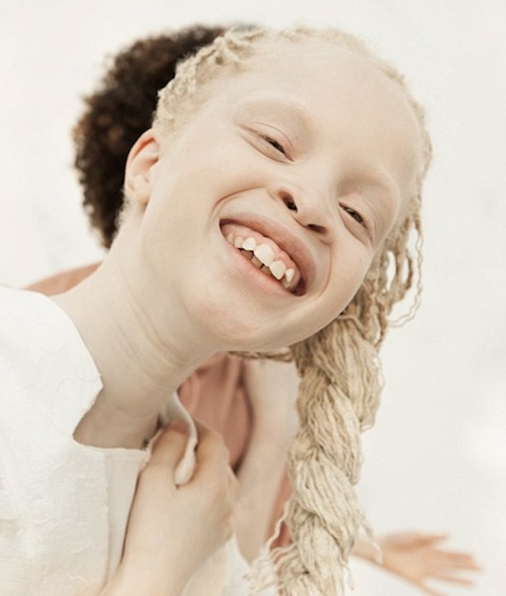 These Stunning Twins With Albinism Are Taking the Modeling Industry By Storm – Allure