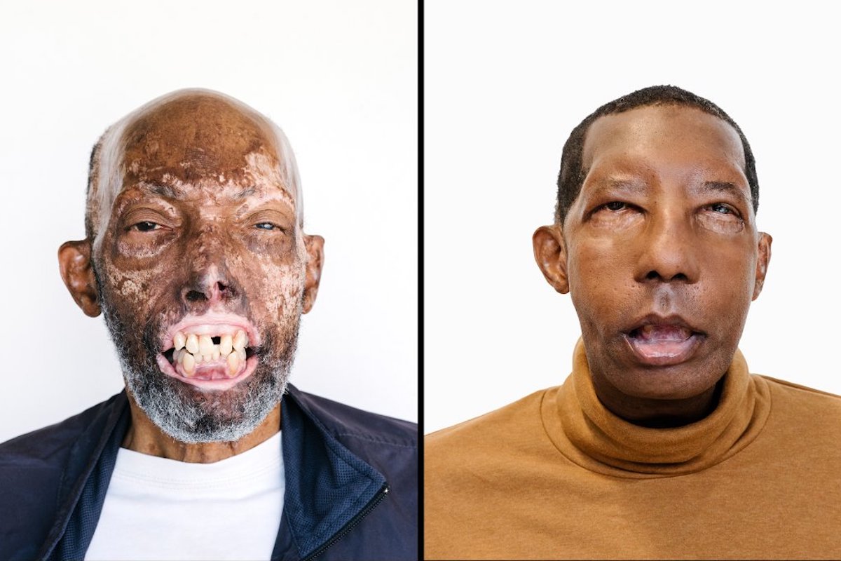 He’s the First African American to Receive a Face Transplant. His Story Could Change Health Care | Time